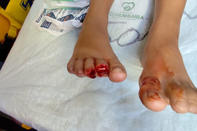 Criança tem dedos arrancados por mordida de Piranhas em Lago de Caldas Novas/Go.